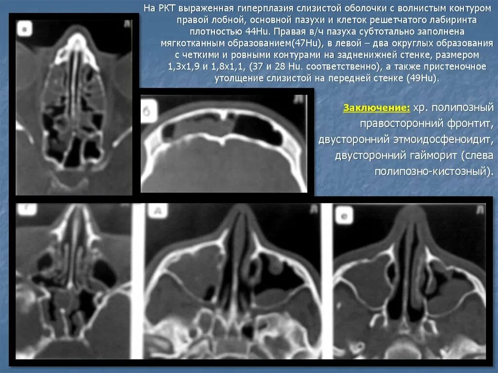 Неравномерное утолщение слизистой оболочки. Мицетома клиновидной пазухи кт. Ячейки решетчатого Лабиринта рентген. Мукоцеле лобной пазухи мрт. Мукоцеле верхнечелюстной пазухи мрт.