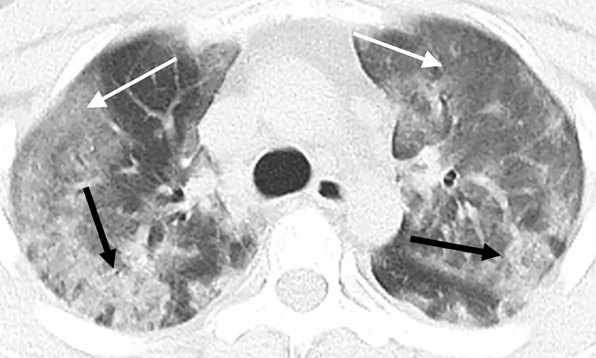 Поражение легких при ковиде. Кт 2 ковид.