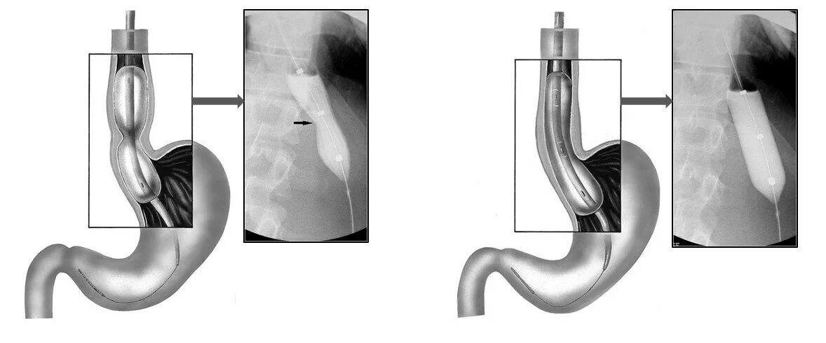 Клапан пищевода и желудка. Ахалазия сфинктера пищевода. Ахалазия кардии баллонная дилатация. Ахалазия пищевода эндоскопия. Ахалазия пищевода баллонная дилатация.