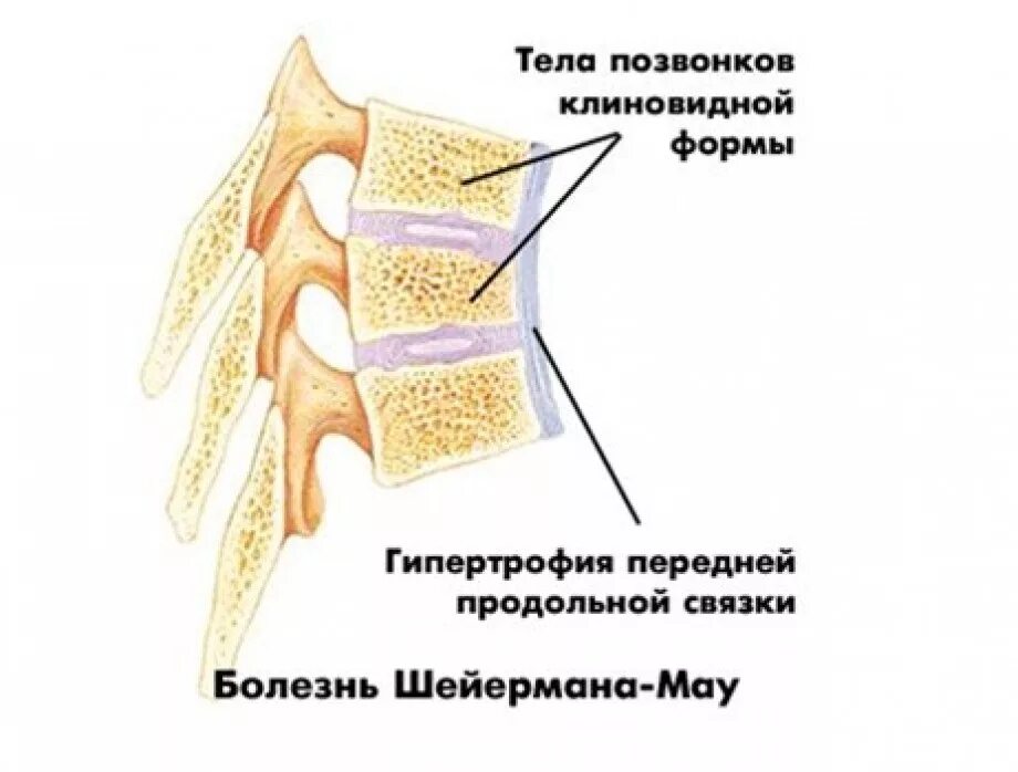 Болезнь шейермана мау что это такое. Болезнь Шойерман-МАУ рентген. Болезнь Шейермана МАУ грудного отдела. Болезнь Шейермана МАУ грудного отдела позвоночника. Клиновидная деформация позвонков поясничного отдела рентген.