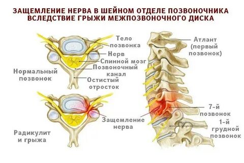 Защемление в грудном отделе лечение