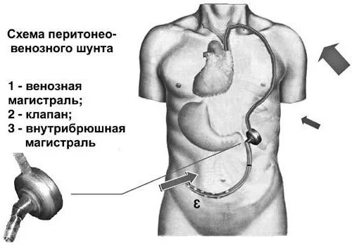 Внутреннее перитонеовенозное шунтирование. Перитонеовенозный шунт при асците брюшной полости. Перитонеовенозное шунтирование при асците.