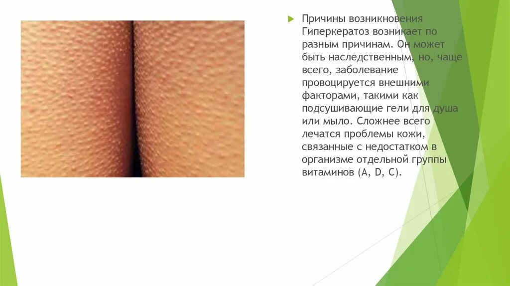Солнечный кератоз