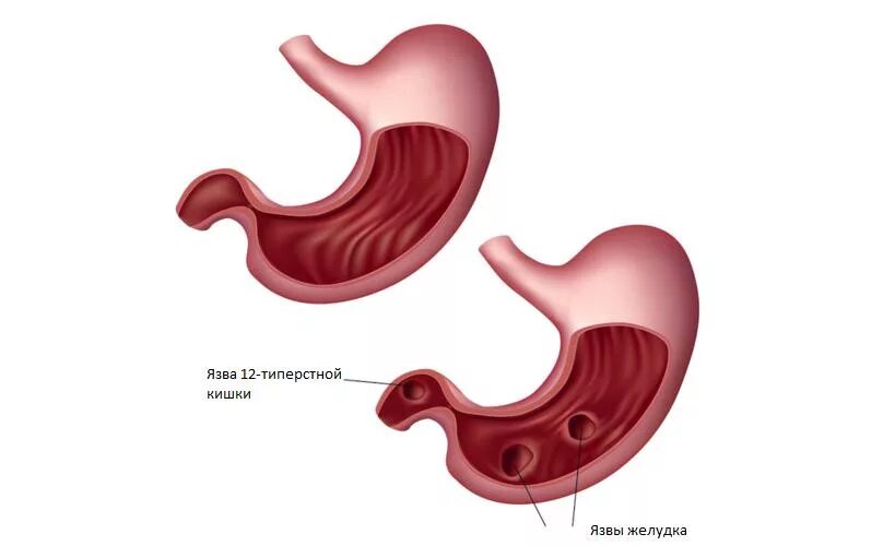 Возникновение язвы желудка. Язва двенадцатиперстной кишки.