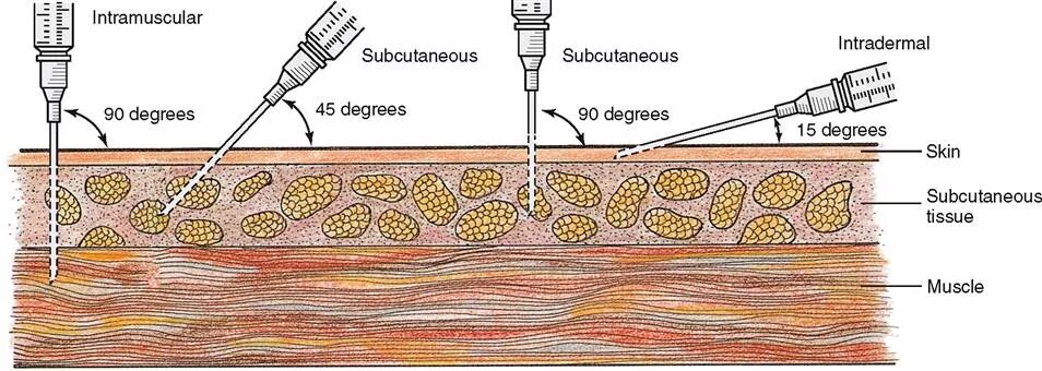Градусы введения иглы. Интрадермальное Введение препарата это. Углы введения иглы при инъекции. Интрадермальная инъекция. Глубина введения иглы при инъекциях.