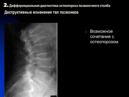 Остеопороз позвоночника поясничного