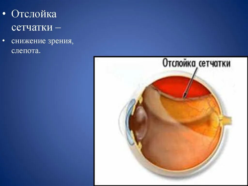 Отслойка сетчатки зрение. Отслойка сетчатки презентация. Травматическая отслойка сетчатки.