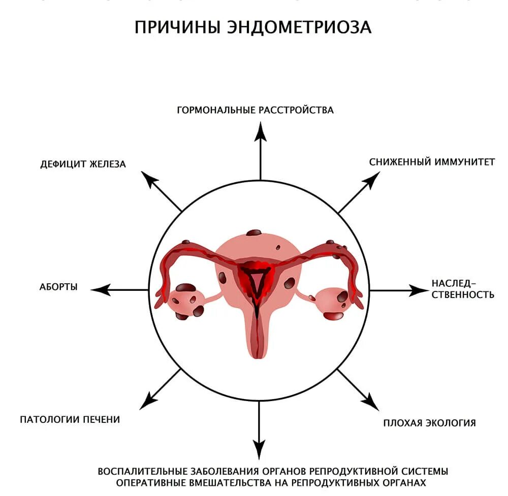 Терапия эндометриоза