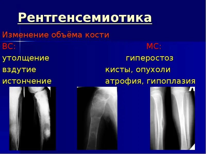 Гиперостоз бедренной кости рентген. Периостит кости рентген. Периостоз бамбергера-мари. Хронический остеомиелит большеберцовой кости кт. Остеомиелит большеберцовой кости рентген.