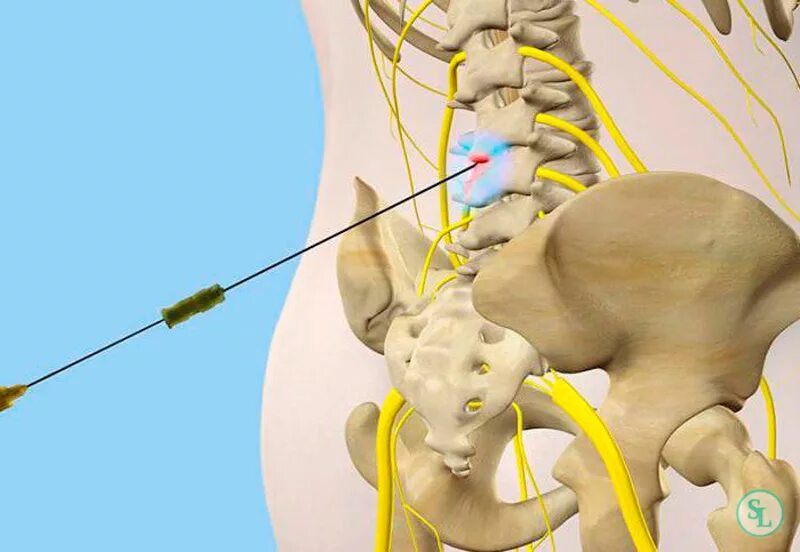 Эпидуральная блокада при грыже позвоночника. Трансфораминальная эпидуральная блокада l5-s1. Блокада грыжи поясничного отдела позвоночника. Пояснично крестцовый отдел операция на позвоночнике