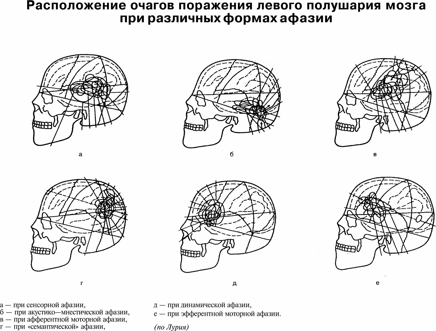 Теменные формы афазии. Афазия очаг поражения. формы афазий очаг поражения таблица. при афферентной моторной афазии очаг поражения расположен. таблица соотношение форм афазии и очаг поражения.