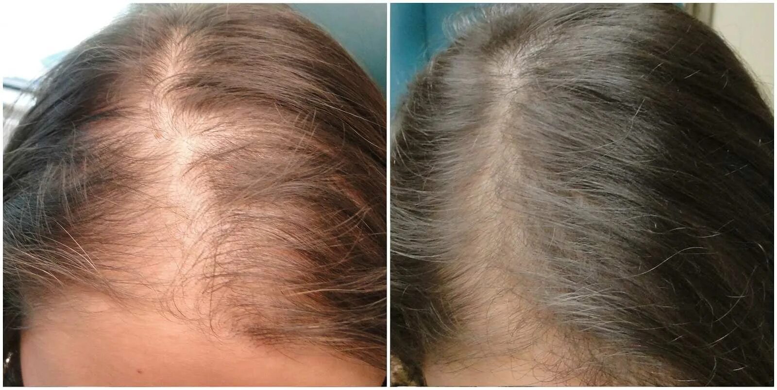 Эффект после лечения. Мезотерапия волосистой части головы до и после. Мезотерапия волос до и после. Мезотерапия кожи головы до и после.