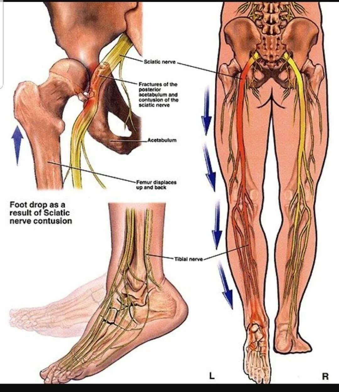 Боль от бедра до стопы. Анатомия седалищного нерва у человека. Седалищный нерв на бедре анатомия. Защемление седалищного нерва анатомия. Седалищный нерв анатомия стопа.