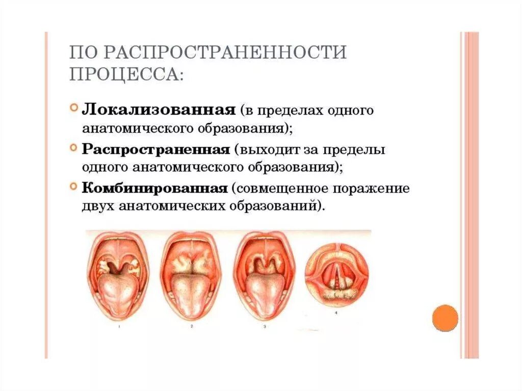 Локализованная дифтерия ротоглотки. Принципы терапии дифтерии ротоглотки. Дифтерия гортани клиника.