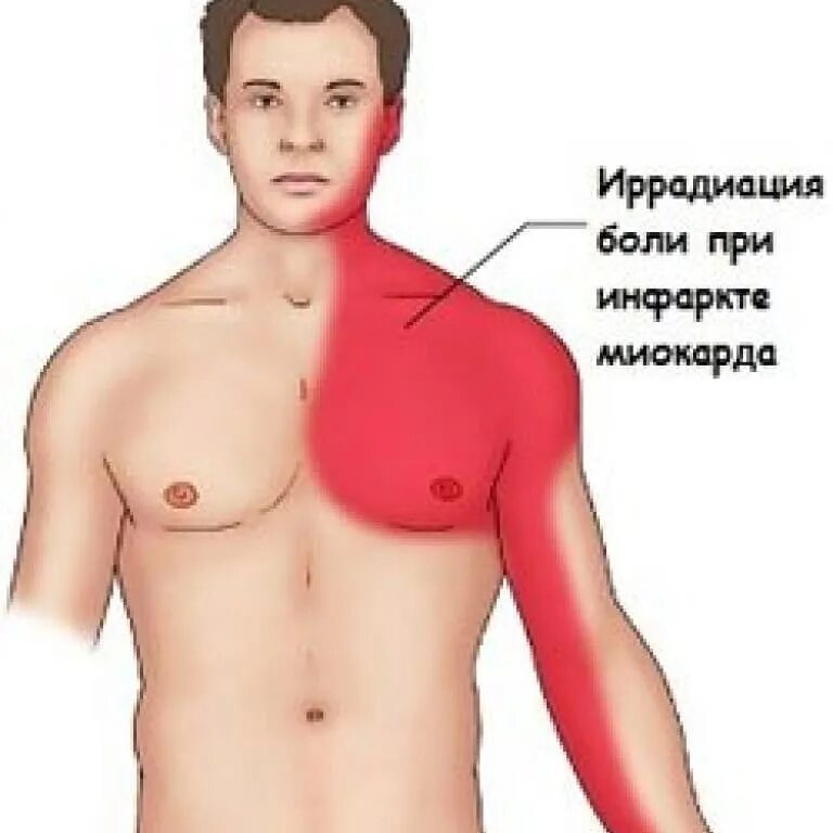Локализация сердечной боли. Сердце в руках. Локализация боли при инфаркте миокарда. В какую руку отдает сердце. Болит сердце и отдает в левую руку.