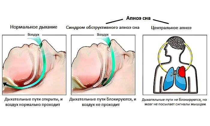 Сплю дышу ртом. Синдром обструктивного апноэ сна симптомы. СОАС синдром обструктивного апноэ сна. Синдром обструктивного апноэ сна у ребенка. Синдром центрального апноэ.