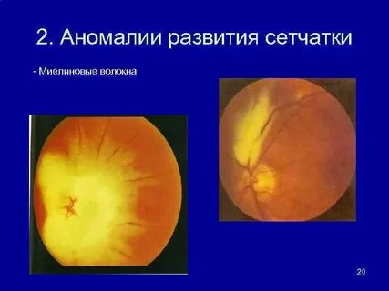 Аномалия развития зрительного нерва