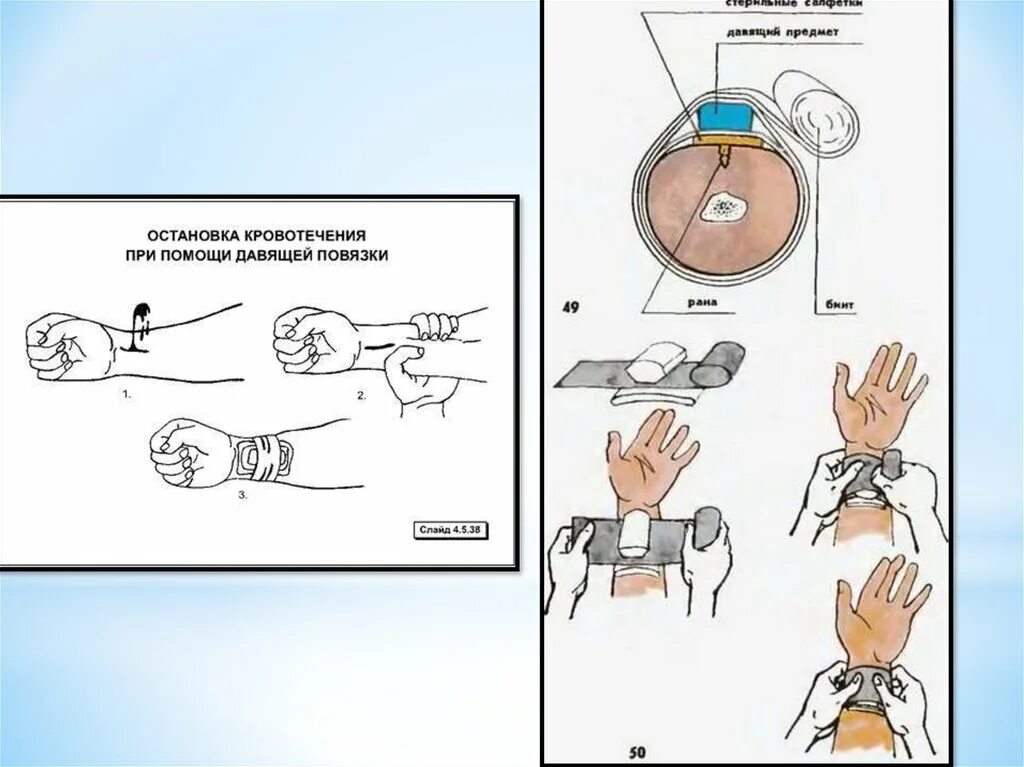 Давящая повязка алгоритм. Наложение давящей повязки при кровотечении. Наложение давящей повязки алгоритм.