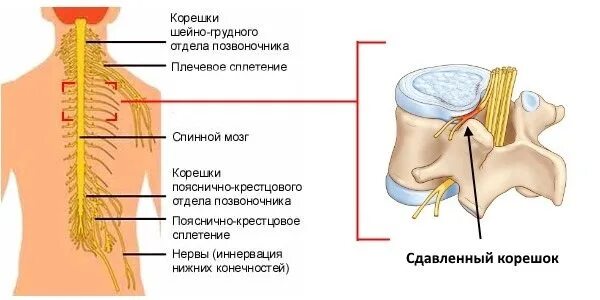 Поражение корешковых нервов. Корешковый синдром грудного отдела. Защемление Корешков спинного мозга симптомы. Сдавление Корешков шейного отдела позвоночника. Сдавливание нервных Корешков в грудном отделе.