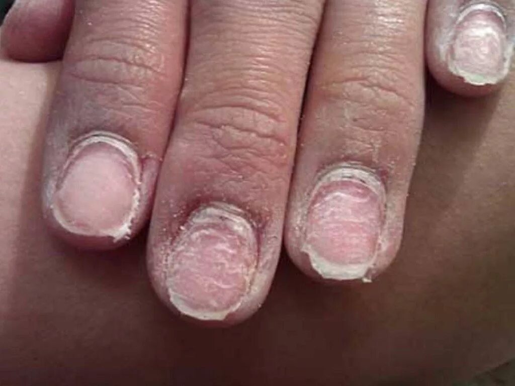 Болят ногти после снятия гель. Травматичный онихолизис. Ониходистрофия - онихолизис.. Онихолизис синегнойная.