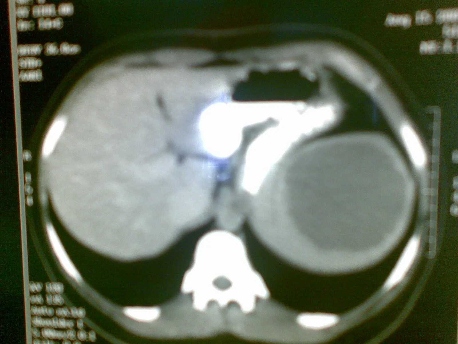 после пункции кисты молочной