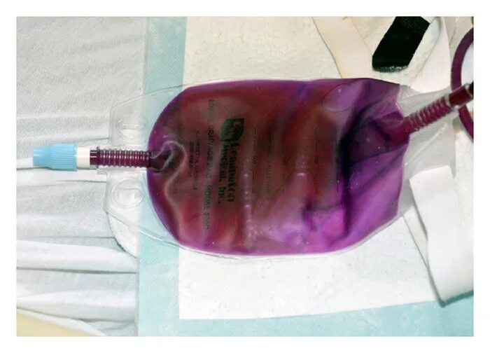 Ru. Сине фиолетовая моча. Розовая моча у ребенка. Фиолетовая моча. Фиолетовая моча.