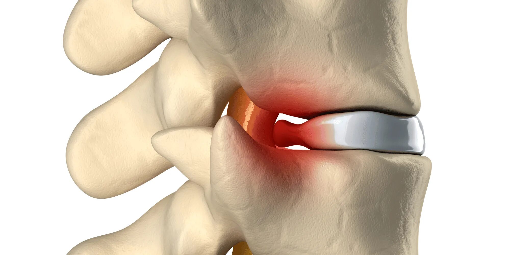 Болит ли протрузия. Протрузия позвоночных дисков. Межпозвоночные грыжи и протрузии. Межпозвоночная грыжа и протрузия. Циркулярная грыжа межпозвонкового диска.