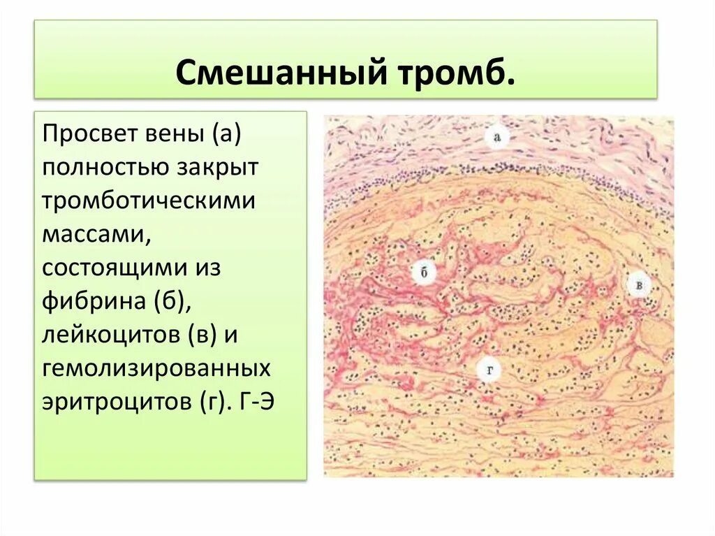 Смешанный тромб