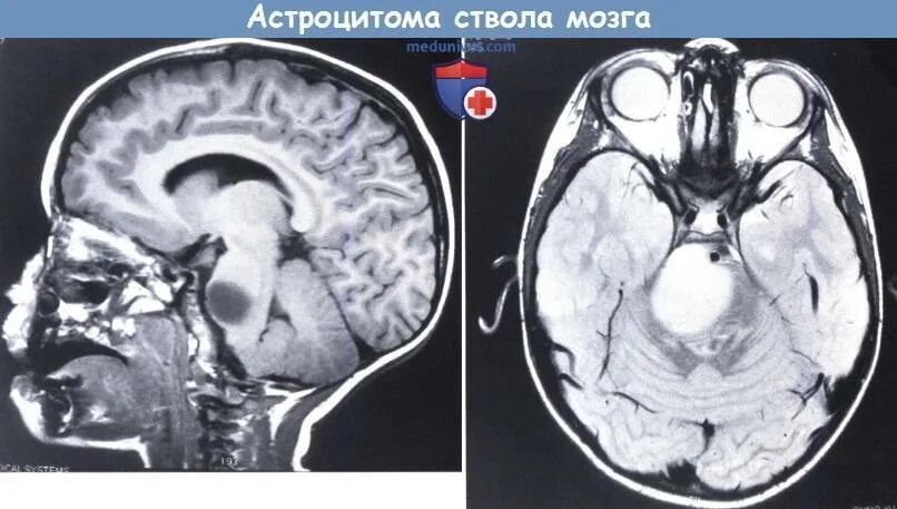 Глиома у детей. Опухоль головного мозга глиома. Астроцитарная опухоль головного мозга.