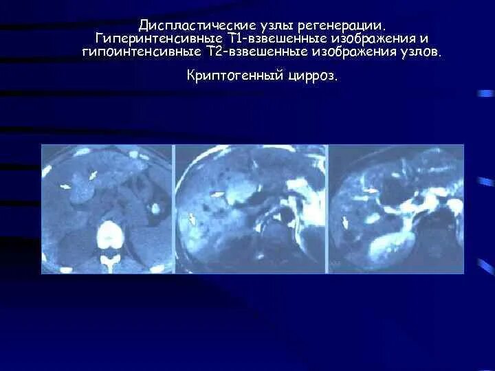 Узлы регенерации. Регенераторный диспластический узел в печени. узлы регенерации печени.