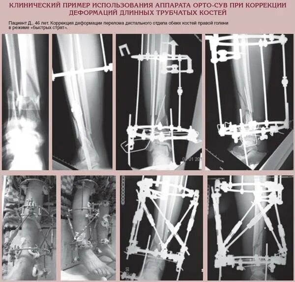Укорочение трубчатых костей. Аппарат внешний фиксации TST. Скоба ганца аппарат внешней фиксации. Аппарат внешней фиксации бедра. Аппарат внешней фиксации голени.