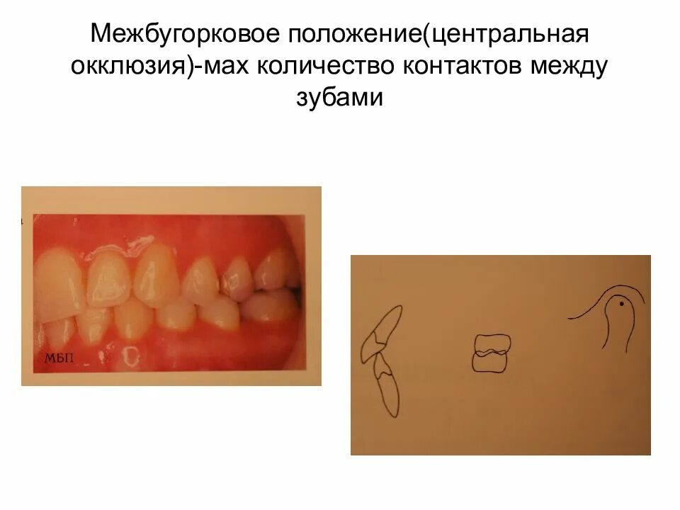 Артикуляция зубов. Центральная окклюзия. Свободная Центральная окклюзия. Центральная окклюзия зубов. Sentralni okluzziya.