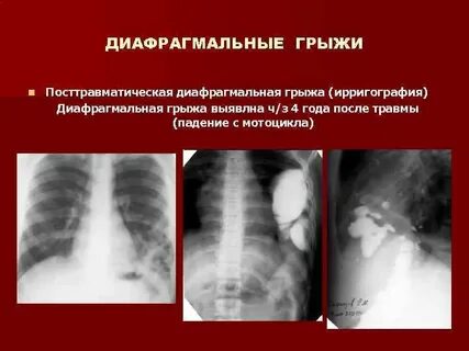 Диафрагмальная грыжа причины