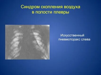 Эмфизема плевры