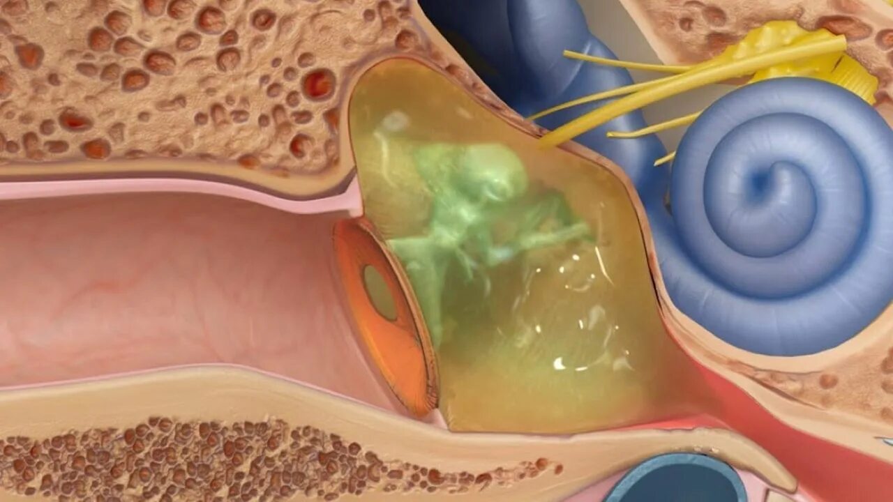 Экссудативный отит барабанная перепонка. Гнойный слухи