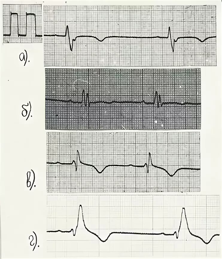 Расщепление зубца. Комплекс qrs в v1. расщепление зубца r в v3. расщепление зубца s в v1. qrs v1 расщеплен.
