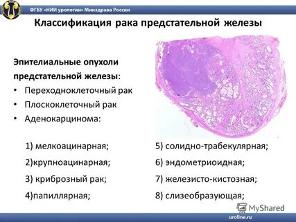 Что такое онкология предстательной железы