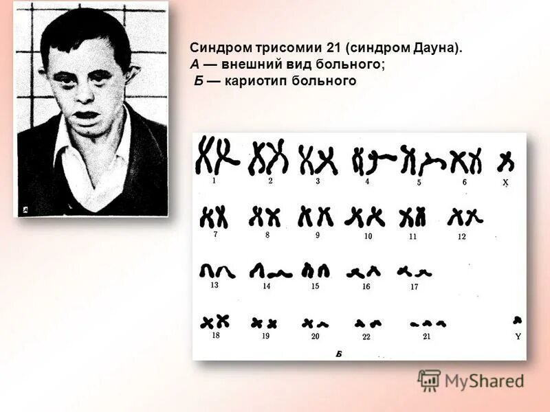 Синдром вольфа кариотип. Синдром орбели кариотип. кариотип вольфа-хиршхорна. синдром вольфа-хиршхорна. синдром вольфа кариограмма.
