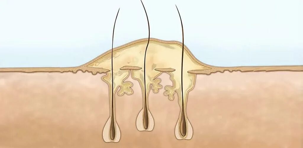 Растут корни волос. Фолликул фурункул карбункул. Фурункул волосяного фолликула. Фурункулез волосяных фолликулов.