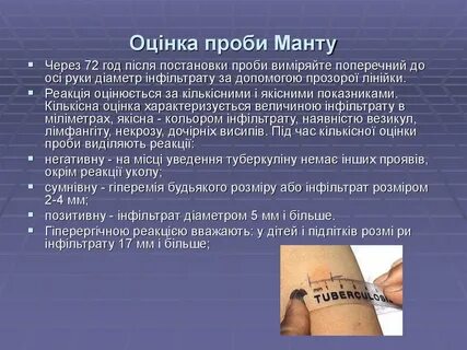 Проба туберкулина