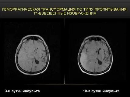 Геморрагическая трансформация ишемического инсульта