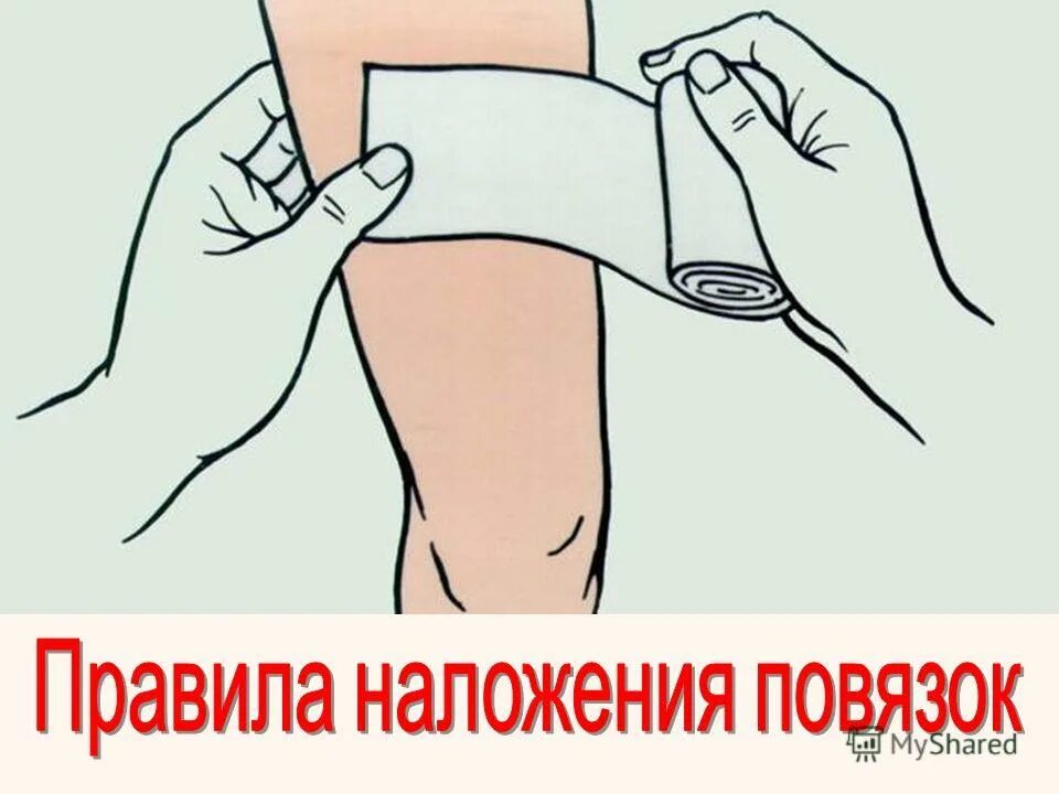 Десмургия повязки алгоритм. При наложении повязки конец бинта следует. Типы бинтовых повязок на кисть. Порядок наложения бинтовой повязки. При наложении повязки на конечность, бинтование осуществляют:.