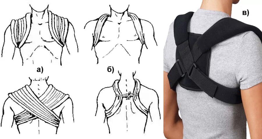 транспортная иммобилизация при переломе ключицы. грудино ключичный сустав подвывих. косыночная повязка для иммобилизации верхней конечности. иммобилизация пострадавшего при переломе верхней конечности. при травме ключицы используют.