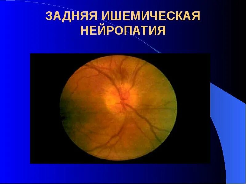 Ишемическая нейропатия глаза. Передняя ишемическая нейропатия зрительного нерва. Нейрооптикопатия зрительного нерва. Ишемическая нейропатия глаза. Передняя ишемическая нейропатия.