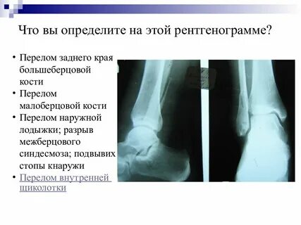 Как распознать перелом ноги