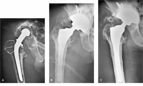 Имплант тазобедренного сустава титан. Срок службы тазобедренного эндопротеза. Перелом шейки бедра эндопротезирование рентген. Гемипротез тазобедренного сустава. Эндопротезирование шейки бедра.
