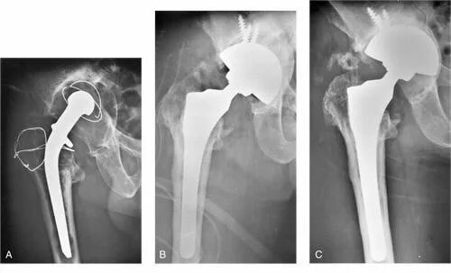 Перипротезная инфекция тазобедренного сустава. Срок службы эндопротеза тазобедренного сустава. Перипроетжная инфекция тазобедренного сустава. Перипротезная инфекция коленного сустава.