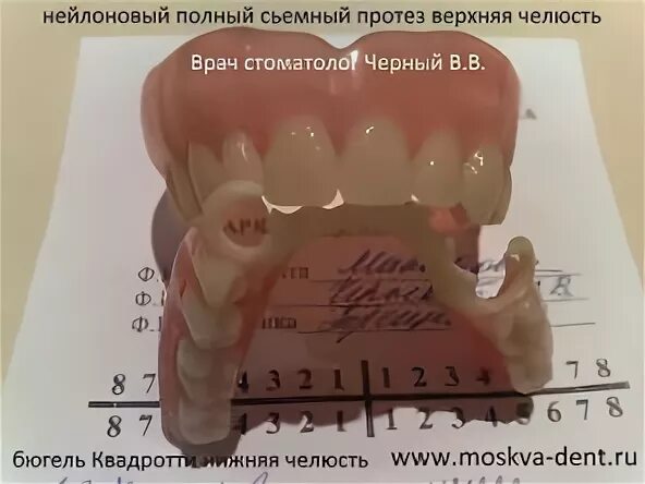 Протез квадротти на верхнюю челюсть отзывы