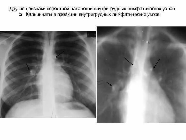 Лимфоузел в легком причина. Множественные кальцинаты в легких рентген. Кальцинат в легком рентген. Кальцинаты внутригрудных лимфоузлов.