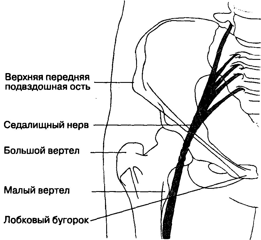 Блокада при защемлении седалищного. Схема блокады седалищного нерва. Блокада бедренного нерва регионарная анестезия. Техника блокады седалищного нерва по Войно-Ясенецкому. Блокада бедренного, седалищного и запирательного нервов.